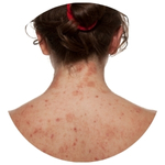 Allergy-Related Eczema
