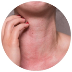 Skin Allergies
