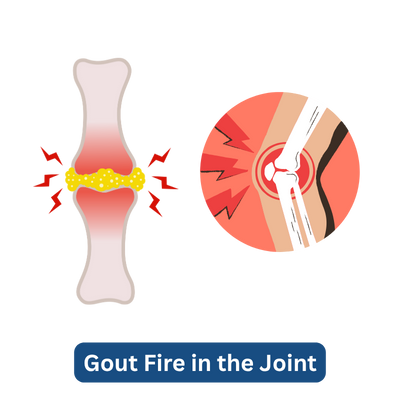 Gout Fire in the Joint