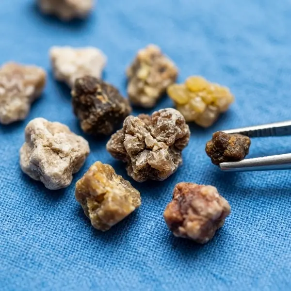 Kidney Stones