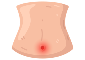 Belly Button Infection