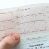 Atrial Fibrillation